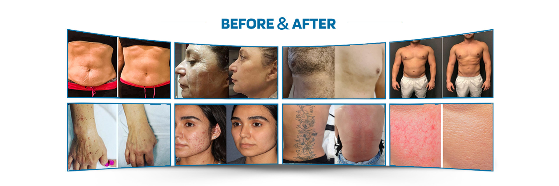 品質 レーザーの毛の取り外し機械 工場