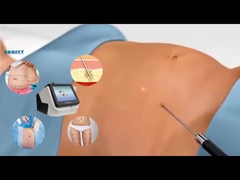 激光リポ機器 30W 60W 980nm ダヨドリポレーザー 減量用